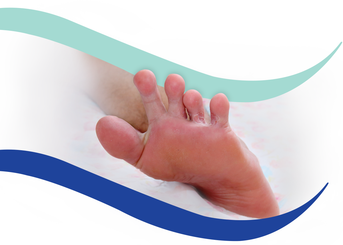 Athletes foot treatment - Podiatrist in Hove and Brighton - Hove Foot Clinic