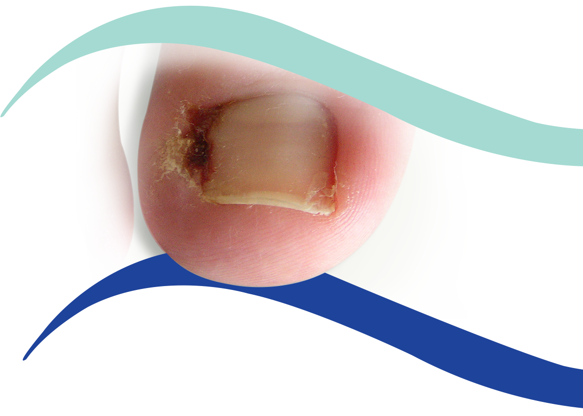 Ingrown toenail treatment - Podiatrist in Hove and Brighton - Hove Foot Clinic