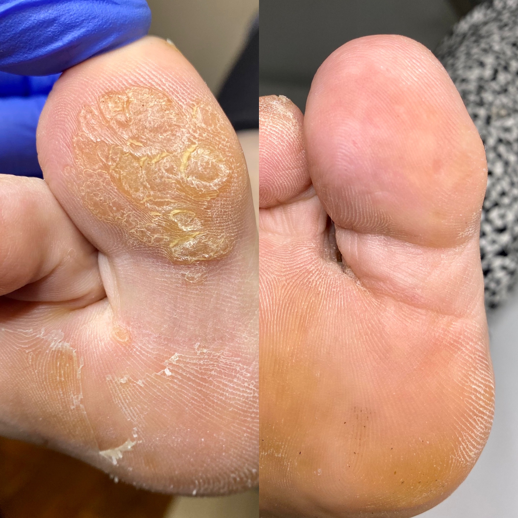 verruca removal